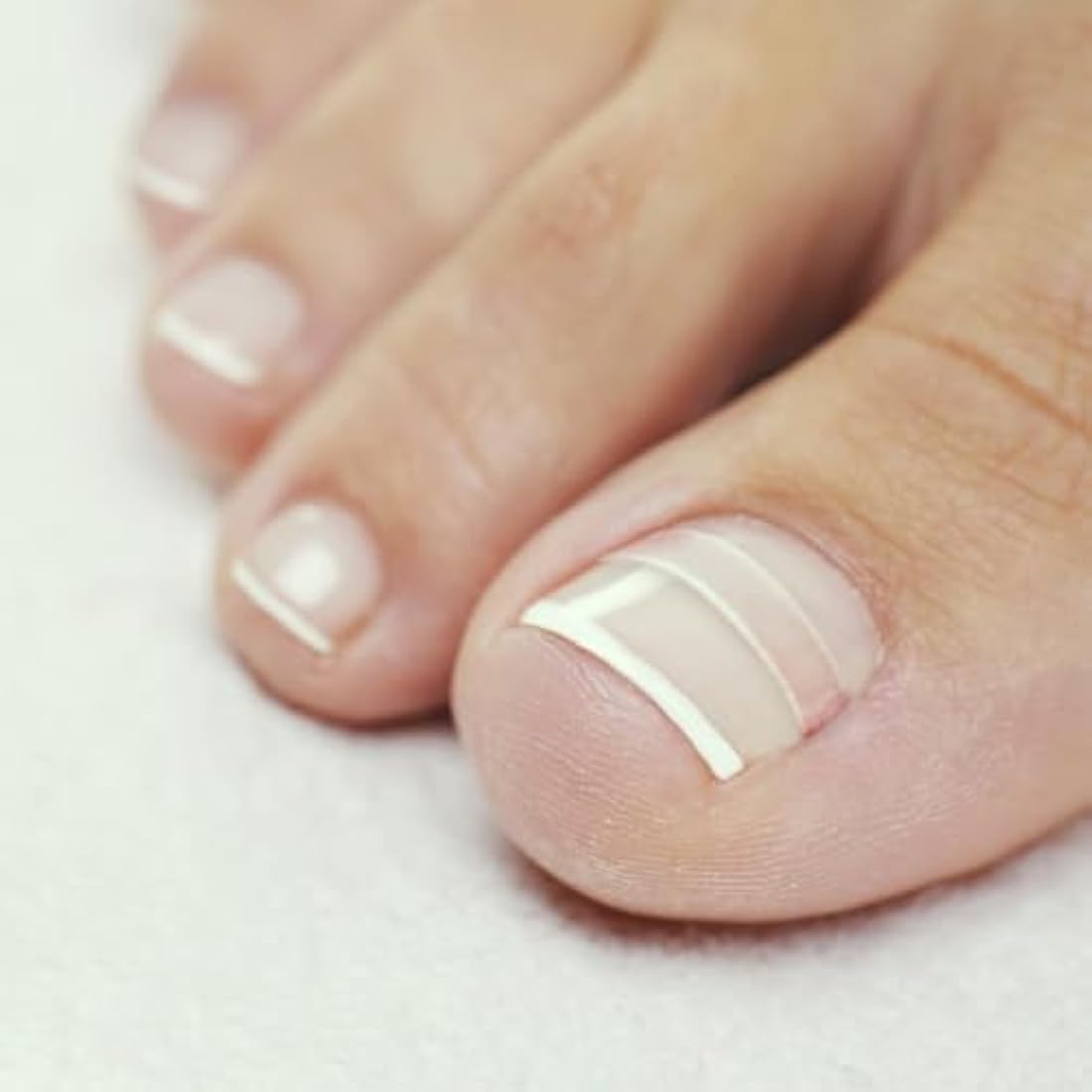 CurveCorrect Ingrown Toenail Home Treatment