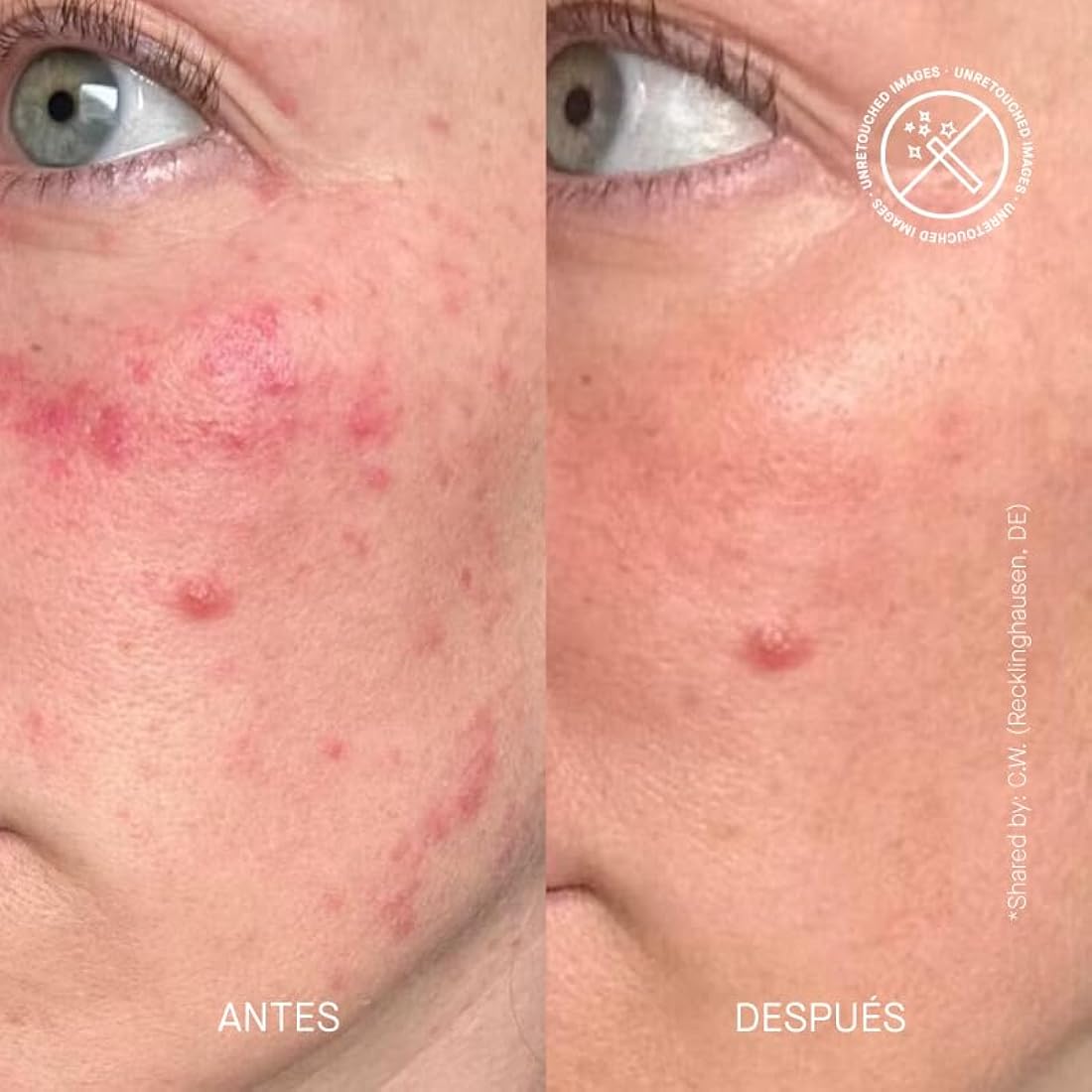 THERAMID CERAMIDE TREATMENT - High-Dose Ceramide Treatment